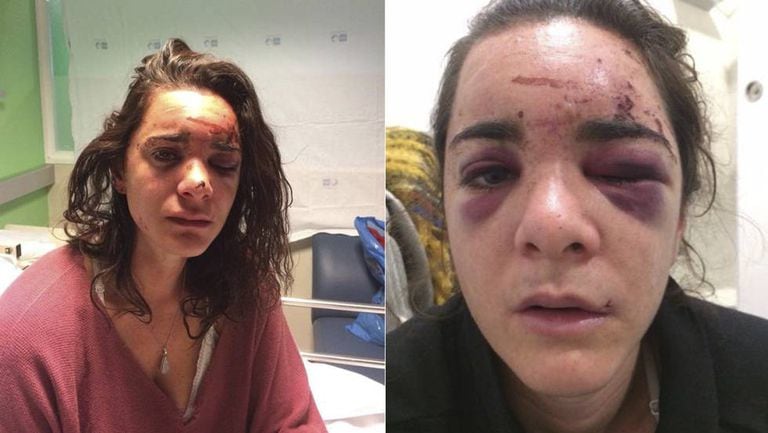 Andrea Sicignano in two photos of herself after the attack that she published on her Facebook account.