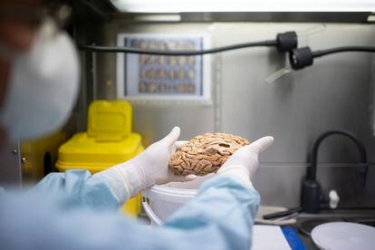 A scientist handles a brain at the CIEN Foundation Tissue Bank.