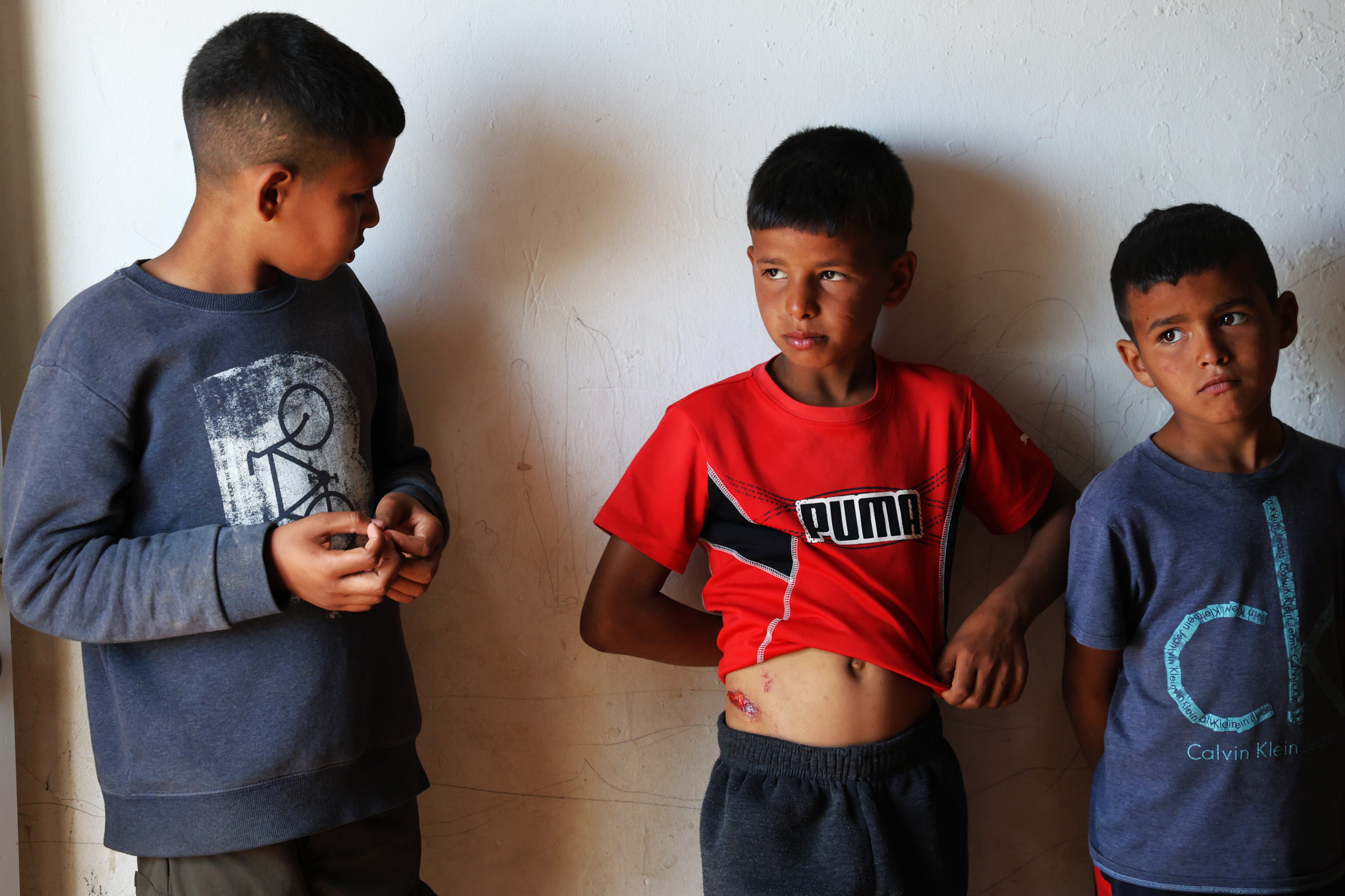 Naser (center), Amina's brother, shows the injury caused while he was running to flee the Iranian attack when a piece of projectile fell into the room where the family was sleeping.